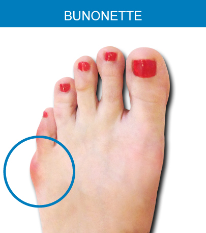 bunionette
